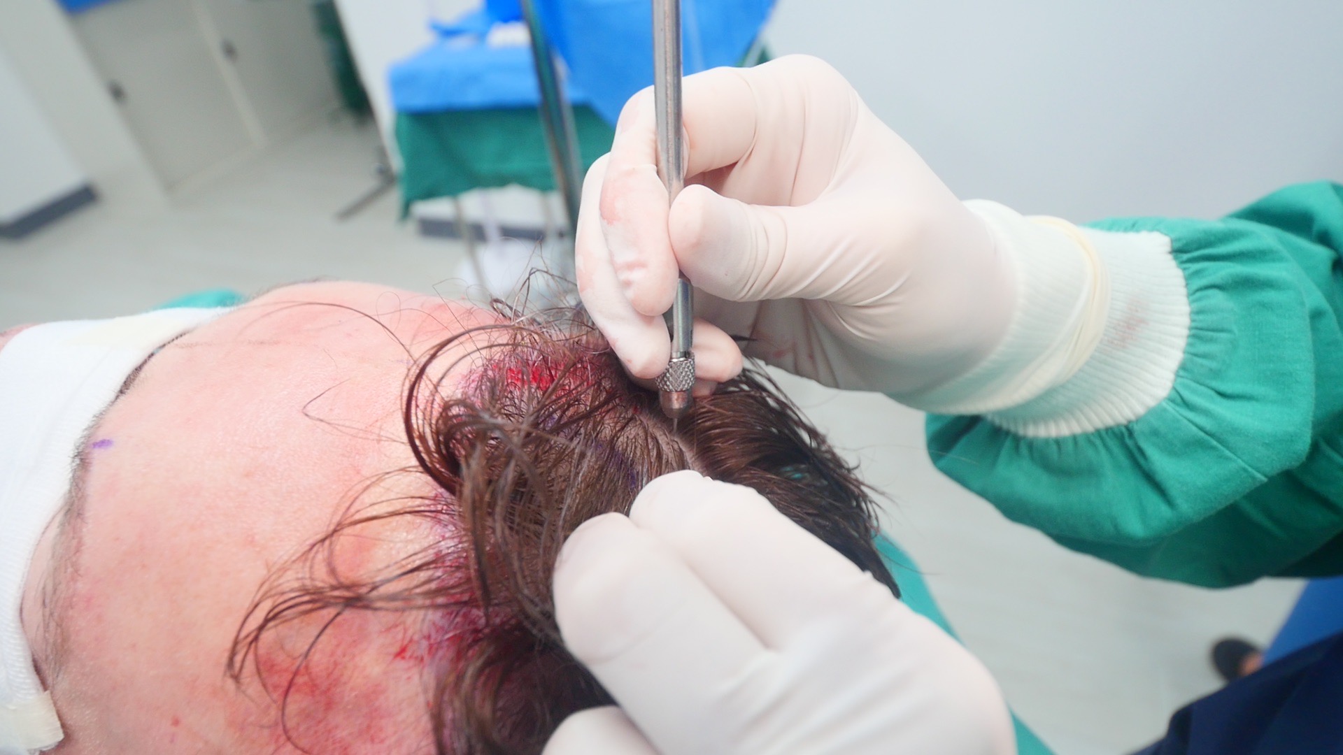 Hair follicle extraction from donor area during FUE hair transplant procedure