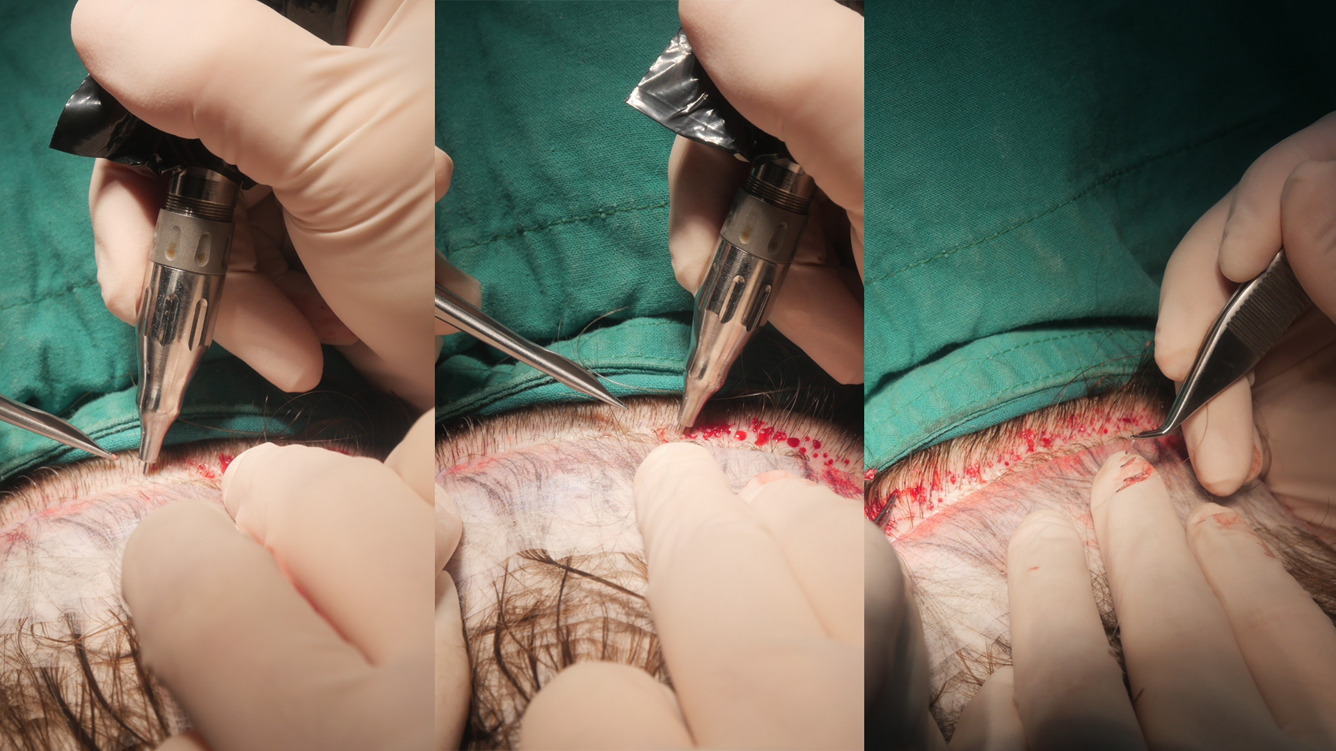 In a FUE hair transplant, the doctor has to remove individual hair follicles