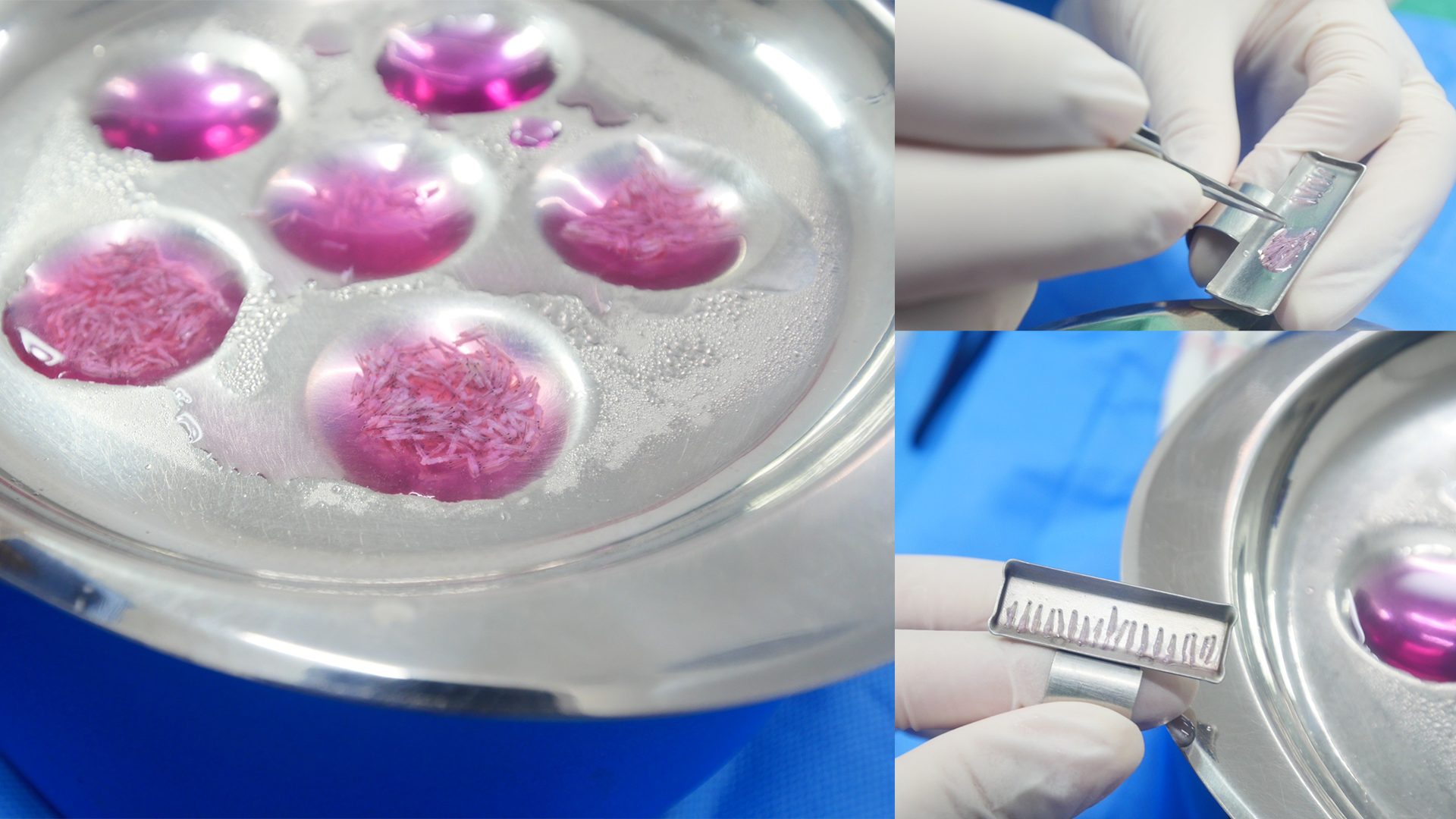 Hair follicle grafts preserved in solution during FUE hair transplant preparation