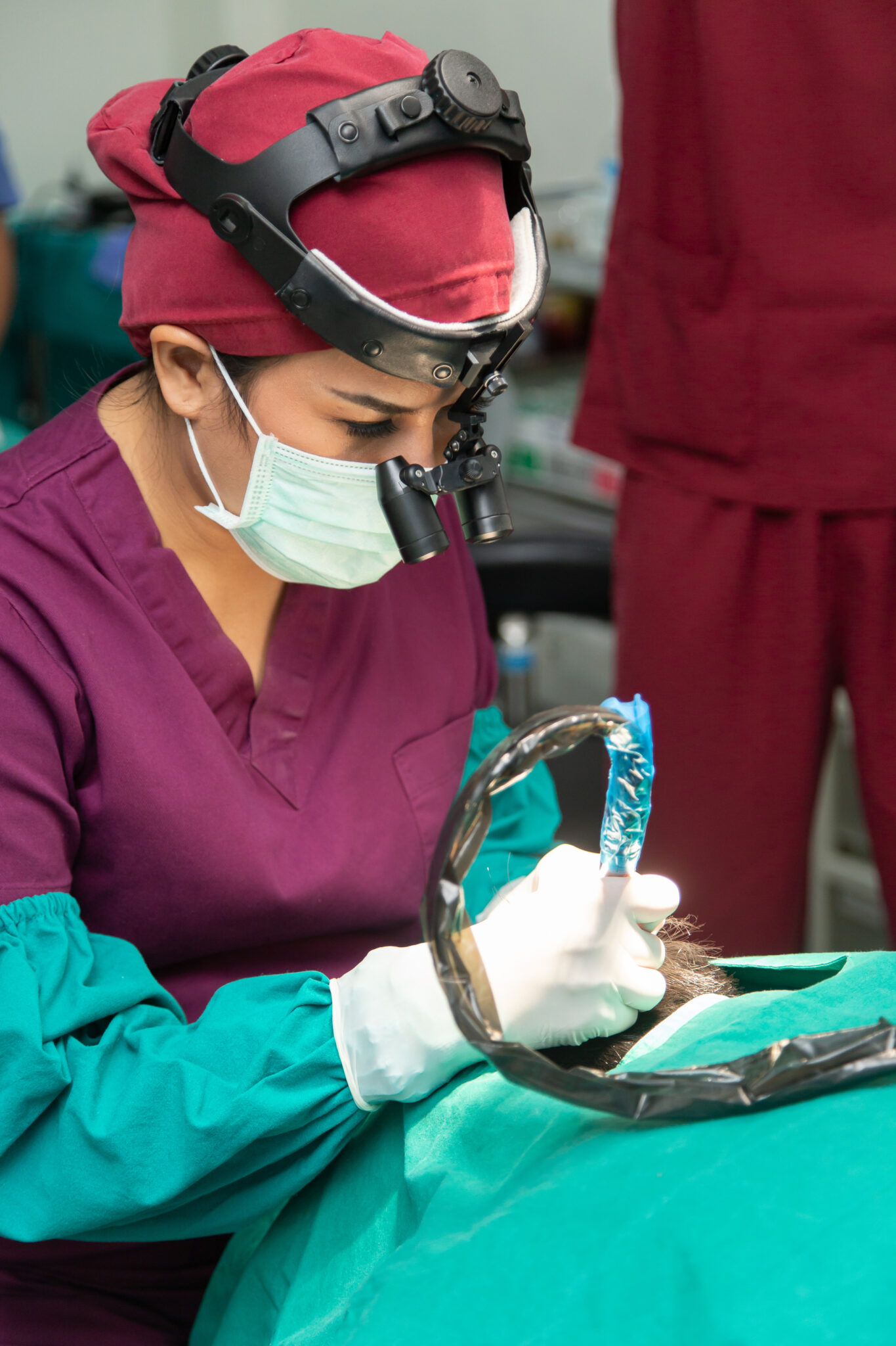 The hairline design is one of a FUE hair transplant process